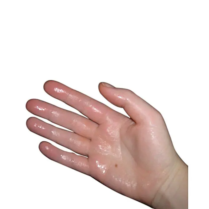 Iontophoresis Machine For Sweaty Hands And Feet